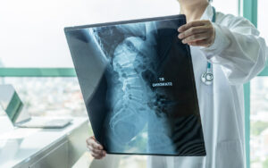 What Caused My Disc Hernia?