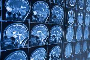 What Are Some Causes of Brain Injury?