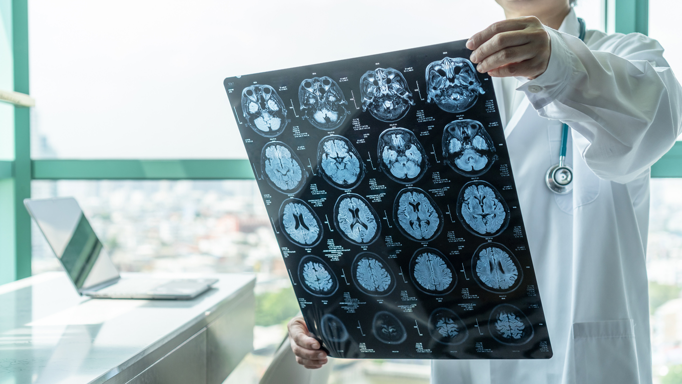 What Is a “Silent Stroke” and How Do You Know if You’re Having One?